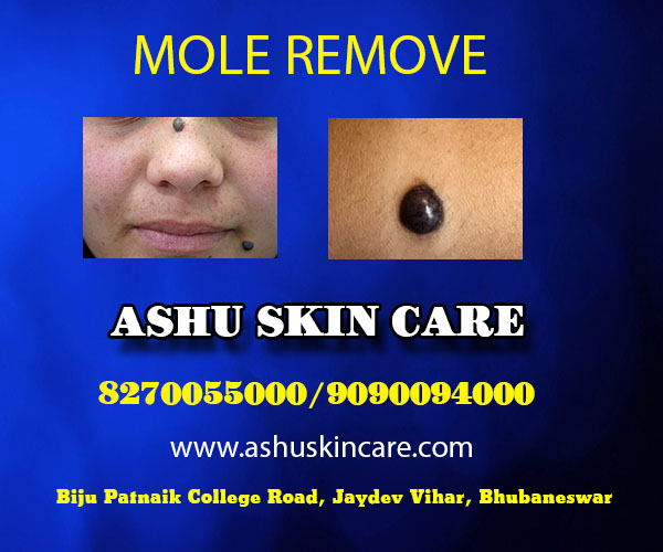 best mole removal clinic in bhubaneswar close to aditya care hospital